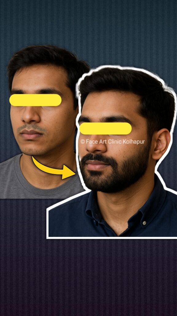 Best Beard Transplant in Kolhapur